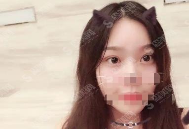 2021齐鲁医院李秀琪双眼皮案例果实在是太完美了，术后较为自然！