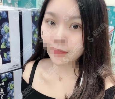 2021齐鲁医院李秀琪双眼皮案例果实在是太完美了，术后较为自然！