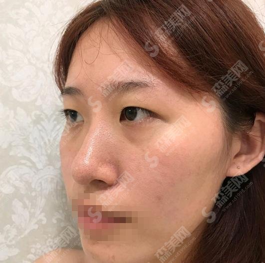 2021媚眼术是什么?媚眼术的果怎么样?附真人案例前后对比