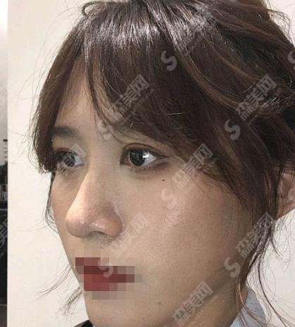 2021媚眼术是什么?媚眼术的果怎么样?附真人案例前后对比