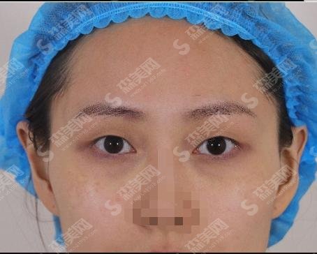 2021上海眼王是谁?他做的双眼皮眼部手术真的那么牛?附较新双眼皮价格！