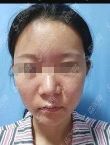 热玛吉新一代做一次需要多少钱？手术的没问题指数有多少？