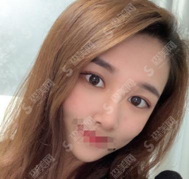 2021双眼皮价格表，项目介绍+优点分享+案例展示