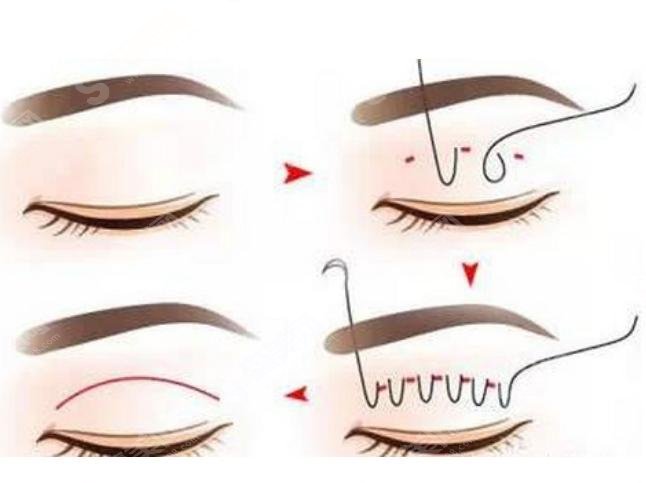 2021双眼皮价格表，项目介绍+优点分享+案例展示