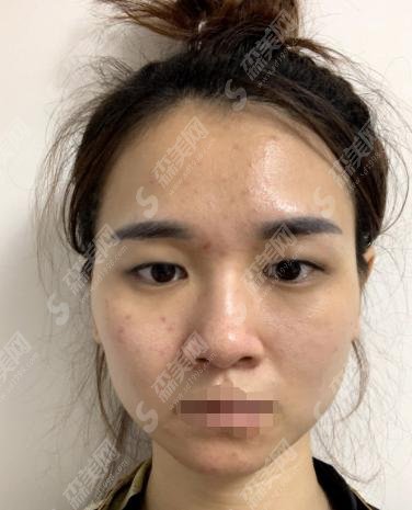 2021双眼皮价格表，项目介绍+优点分享+案例展示