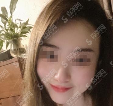 润百颜玻尿酸价格多少一支? 润百颜优点+相关案例分享