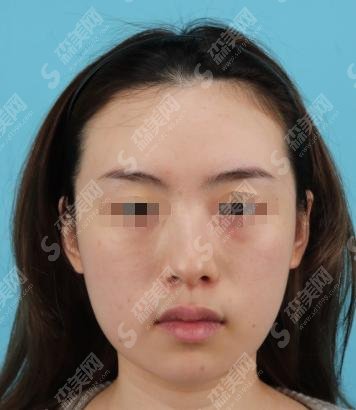 润百颜玻尿酸价格多少一支? 润百颜优点+相关案例分享