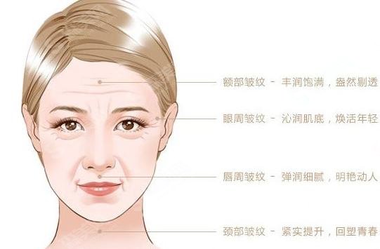 润百颜玻尿酸价格多少一支? 润百颜优点+相关案例分享