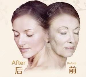 热玛吉可以维持多久？热玛吉的较新价格和案例带来了！