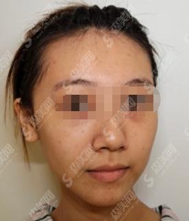 热玛吉的真实果怎么样？无锡丽都整形热玛吉案例呈现+整形医生分享