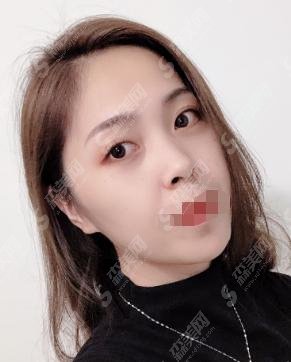 热玛吉的果好么?做完热玛吉注意事项是什么?附案例价格表