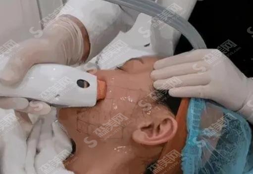 热玛吉的果好么?做完热玛吉注意事项是什么?附案例价格表