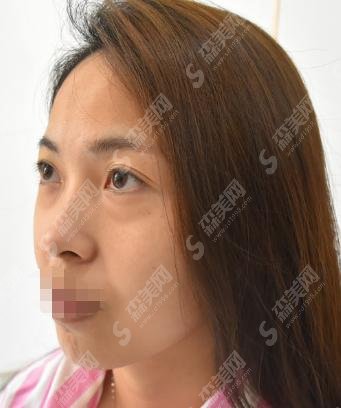 热玛吉的果好么?做完热玛吉注意事项是什么?附案例价格表