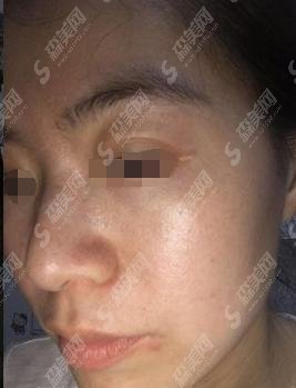 湛江附属医院整形外科祛斑案例怎么样？医院介绍和医生推荐告诉大家！