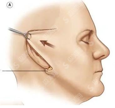 拉皮手术凹陷怎么恢复?拉皮有哪些优缺点？