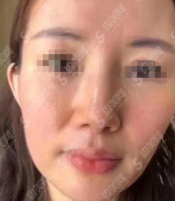 2021热玛吉第五代多少钱?做热玛吉的医院推荐给大家!