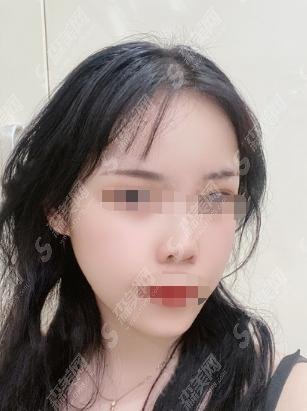 2021埋线提升和热玛吉可以一起做吗？埋线提升一些注意事项和前后果