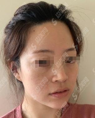 射频和热玛吉的区别？热玛吉的一些后遗症以及案例！
