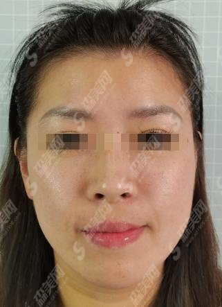 提升针和埋线提升的区别主要在什么地方?埋线提升有哪些危害和副作用!