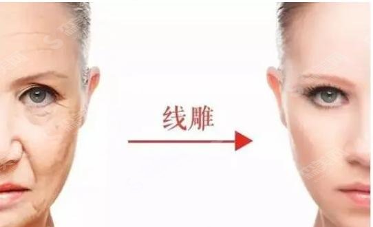提升针和埋线提升的区别主要在什么地方?埋线提升有哪些危害和副作用!
