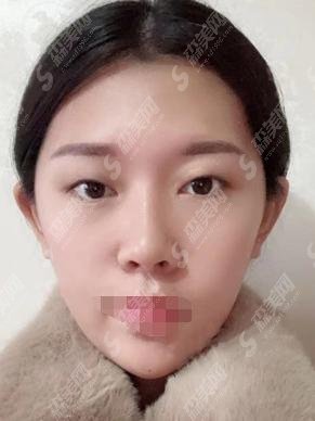 福州海峡医院怎么样？双眼皮闻名当地，李丽强医生的技术叹为观止！