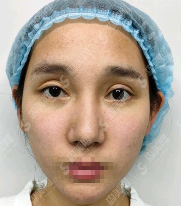 孔宇医生做的双眼皮修复手术好吗?医生怎么样?郑州美艺整形医院+双眼皮修复价格表