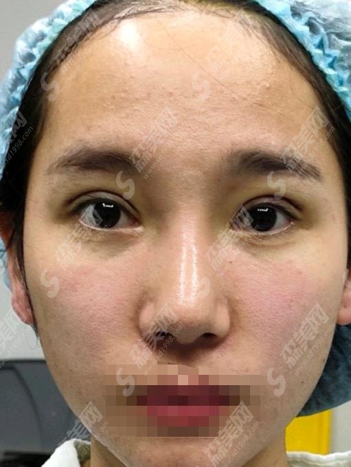 孔宇医生做的双眼皮修复手术好吗?医生怎么样?郑州美艺整形医院+双眼皮修复价格表