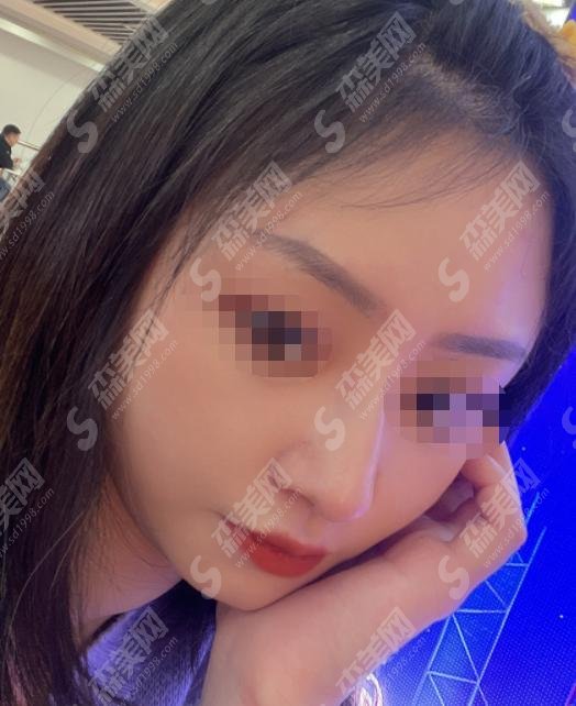 成都鼻修复医生卢元刚如何？医生详情+相关案例分享