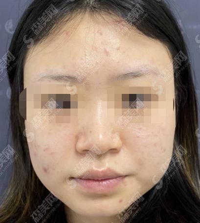 成都鼻修复医生卢元刚如何？医生详情+相关案例分享