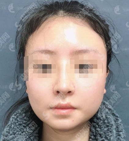 成都鼻修复医生卢元刚如何？医生详情+相关案例分享