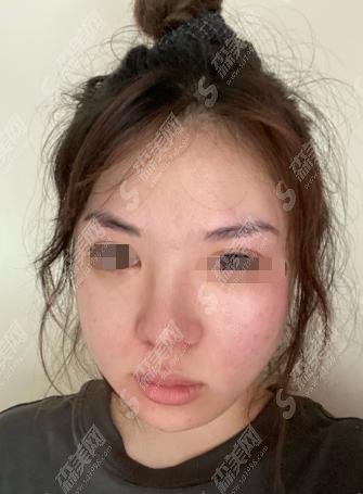 上海九院张余光医生好吗？医生介绍给大家，附医生做的隆鼻果