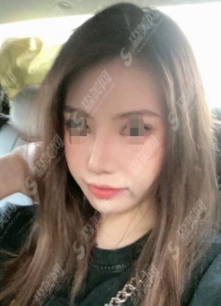 上海九院张余光医生好吗？医生介绍给大家，附医生做的隆鼻果