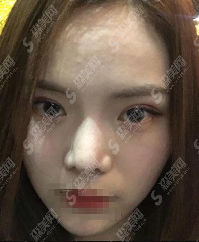 冯幼平医生做的双眼皮果？武汉同济整形医院_医生怎么样_双眼皮