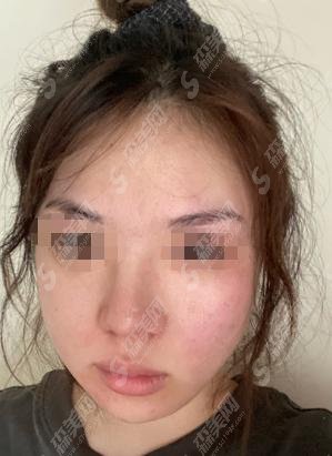 鲁礼新医生怎么样？隆鼻果展现+北京叶子整形医院