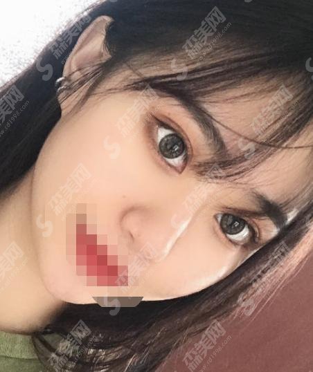 八大处甘承好不好?双眼皮手术做的极为精妙,案例分享见真章!