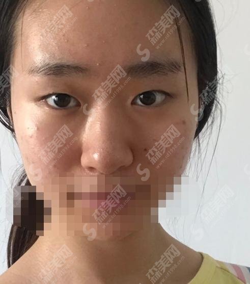 八大处甘承好不好?双眼皮手术做的极为精妙,案例分享见真章!