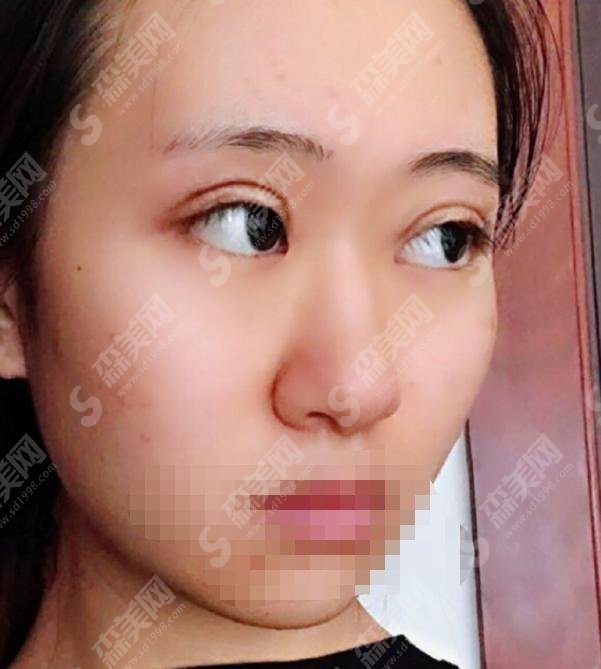 八大处甘承好不好?双眼皮手术做的极为精妙,案例分享见真章!