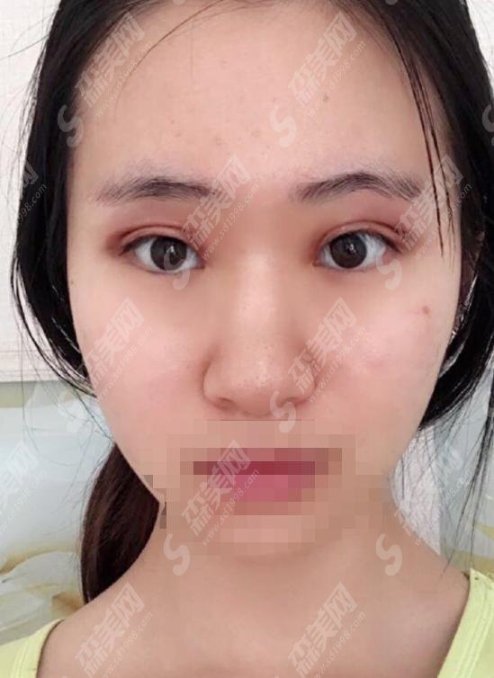 八大处甘承好不好?双眼皮手术做的极为精妙,案例分享见真章!