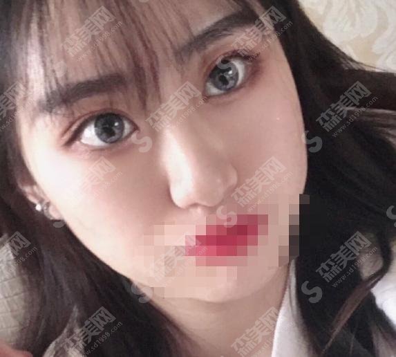 八大处甘承好不好?双眼皮手术做的极为精妙,案例分享见真章!