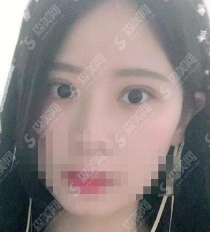 重庆西南医院王量如何？医生简介+双眼皮案例分享附价格表！