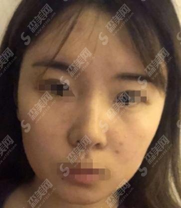 秦皇岛纪辉整形医院怎么样？较新隆鼻医生介绍和手术案例分享！
