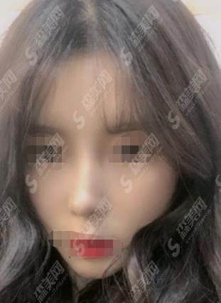 秦皇岛纪辉整形医院怎么样？较新隆鼻医生介绍和手术案例分享！