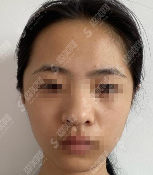 陈文杰医生怎么样？整鼻技术到位，整鼻成功案例分享！