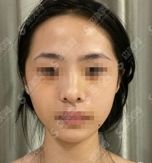 陈文杰医生怎么样？整鼻技术到位，整鼻成功案例分享！