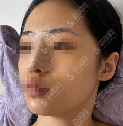 陈文杰医生怎么样？整鼻技术到位，整鼻成功案例分享！