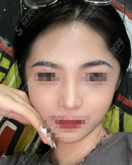 陈文杰医生怎么样？整鼻技术到位，整鼻成功案例分享！
