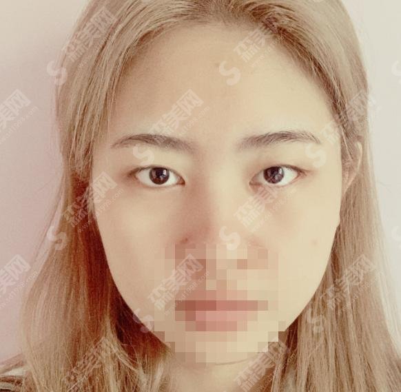 高亮医生怎么样？医生简介+美杜莎双眼皮案例大揭秘！