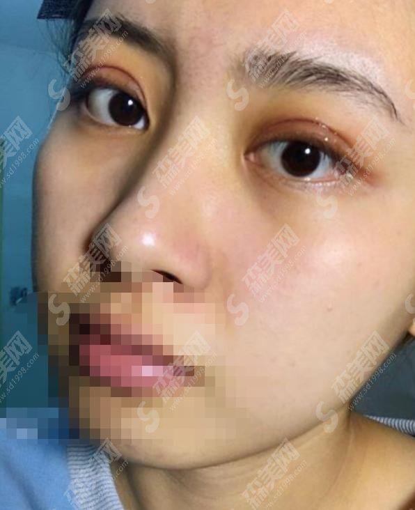 高亮医生怎么样？医生简介+美杜莎双眼皮案例大揭秘！