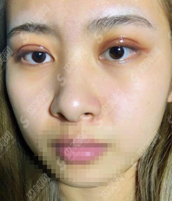 高亮医生怎么样？医生简介+美杜莎双眼皮案例大揭秘！