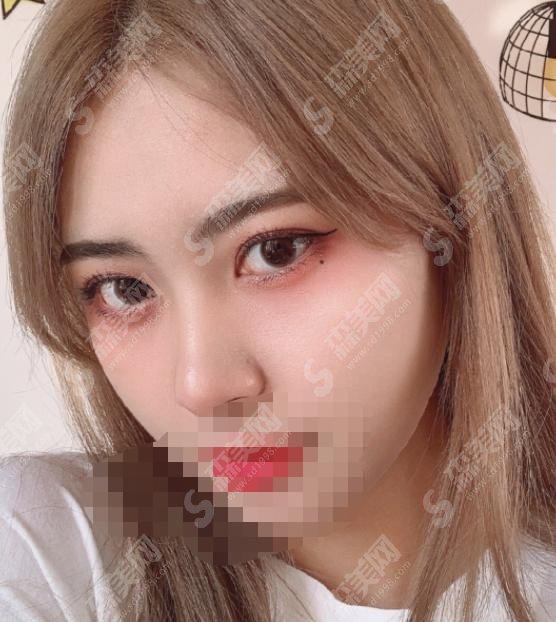 高亮医生怎么样？医生简介+美杜莎双眼皮案例大揭秘！